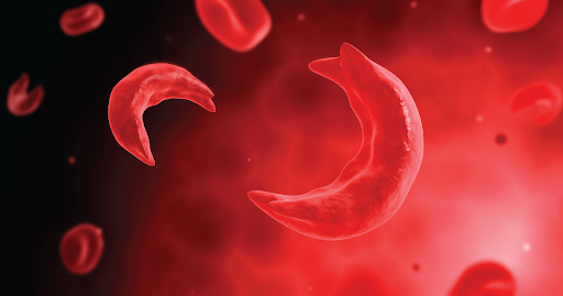Understanding Sickle Cell Anemia: Symptoms and Effective Management